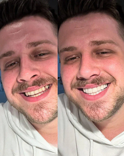 EARLEPS LuxeSmile Biyouyumlu Yeni Nesil Takma Dişler