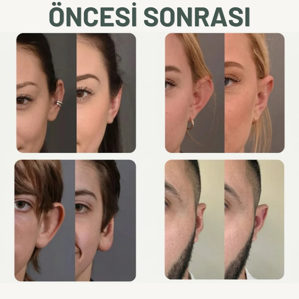 Earleps Kepçe Kulak Klipsi ( Doğal Kulak Şekillendirme ) 20 Adet